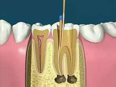 牙疼怎么办？根管治疗，不妨了解一下